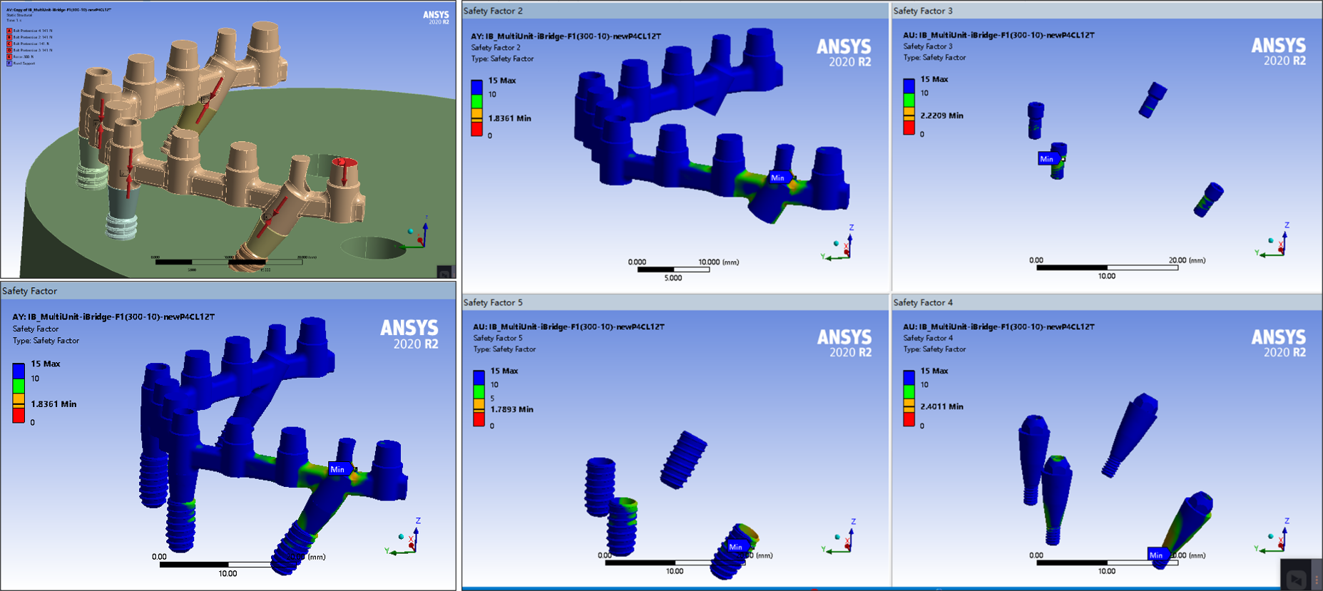 Structural model and finite element analysis of an implant bridge and its connecting components